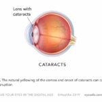 Figure 4-4. The natural yellowing of the cornea and onset of cataracts can contribute to sleep disruption.